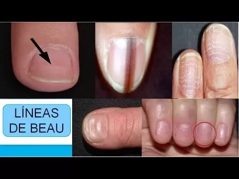 ¿Cómo están tus uñas? Chequeá estas 6 señales de alerta para descartar enfermedades mortales