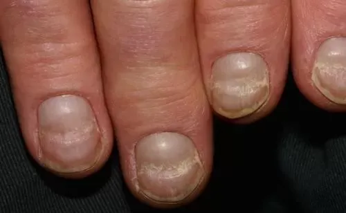 ¿Cómo están tus uñas? Chequeá estas 6 señales de alerta para descartar enfermedades mortales