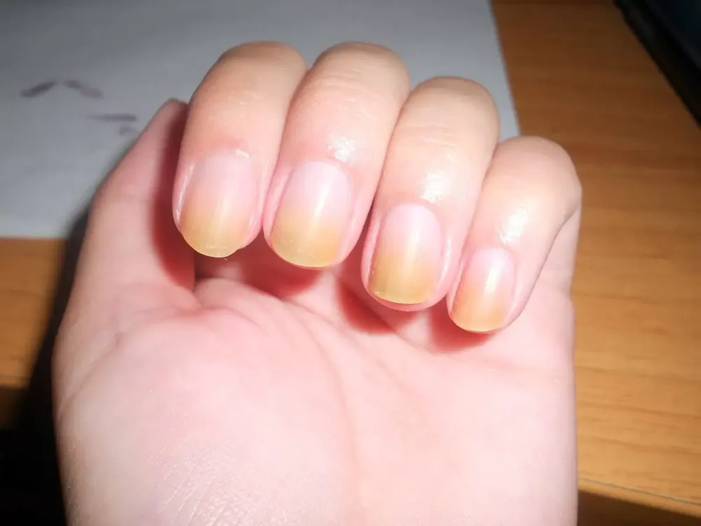 ¿Cómo están tus uñas? Chequeá estas 6 señales de alerta para descartar enfermedades mortales