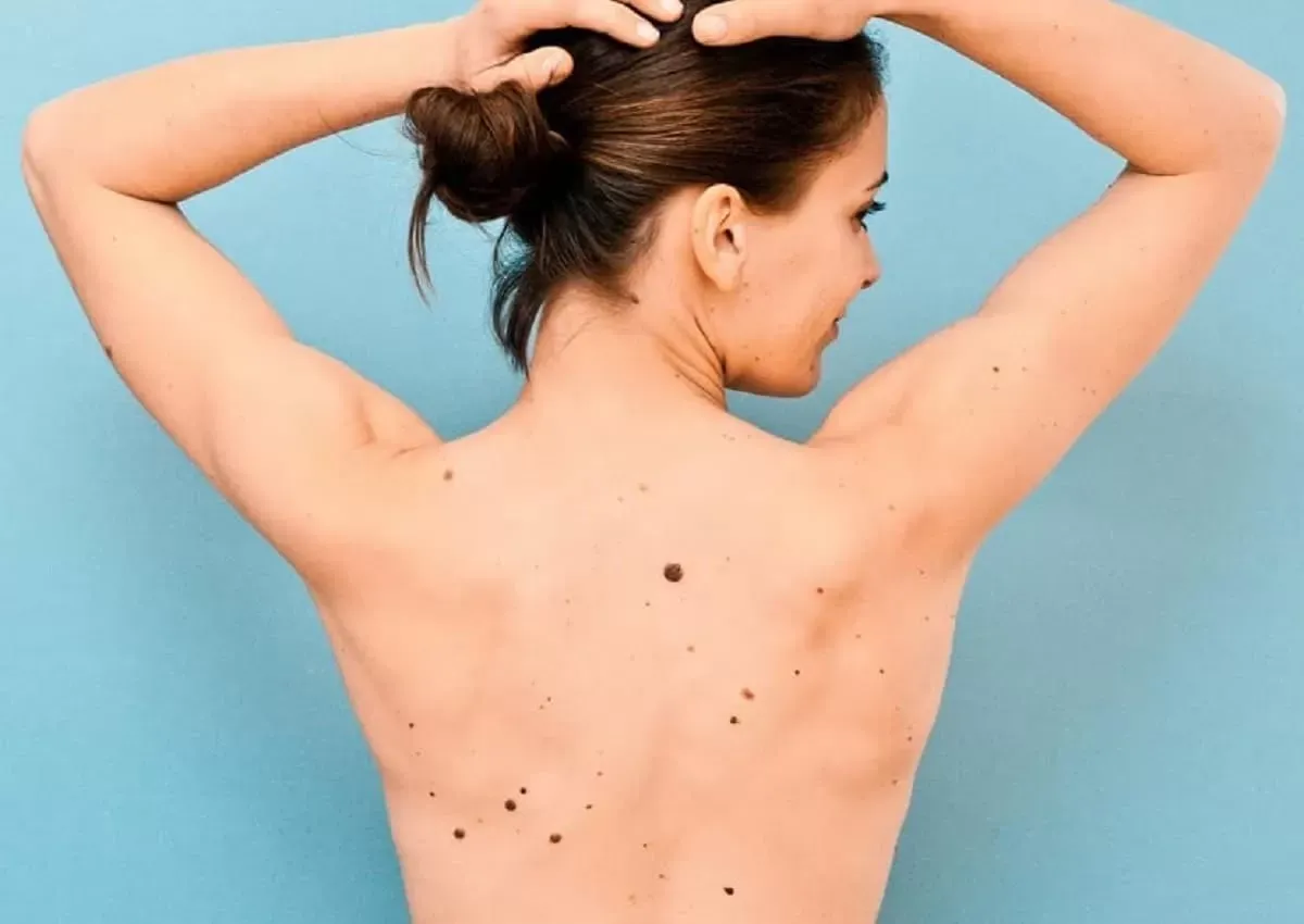 Astrología: ¿Sabías que los lunares de tu cara y tu cuerpo tienen un significado diferente si sos hombre o mujer?