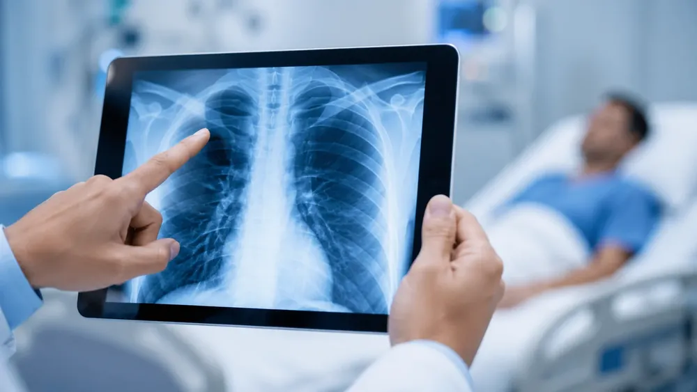 El avance silencioso de la tuberculosis vuelve a encender alertas sanitarias.