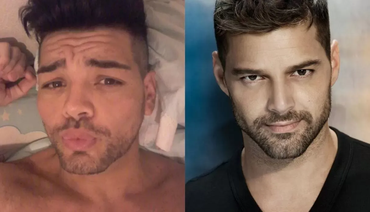 ¡Impresionante! Así quedó después de 28 operaciones para emular a Ricky Martin