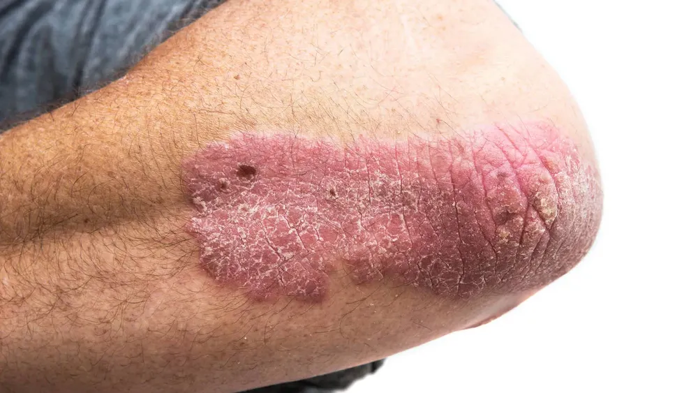 Psoriasis, ¿cómo prevenir esta enfermedad?