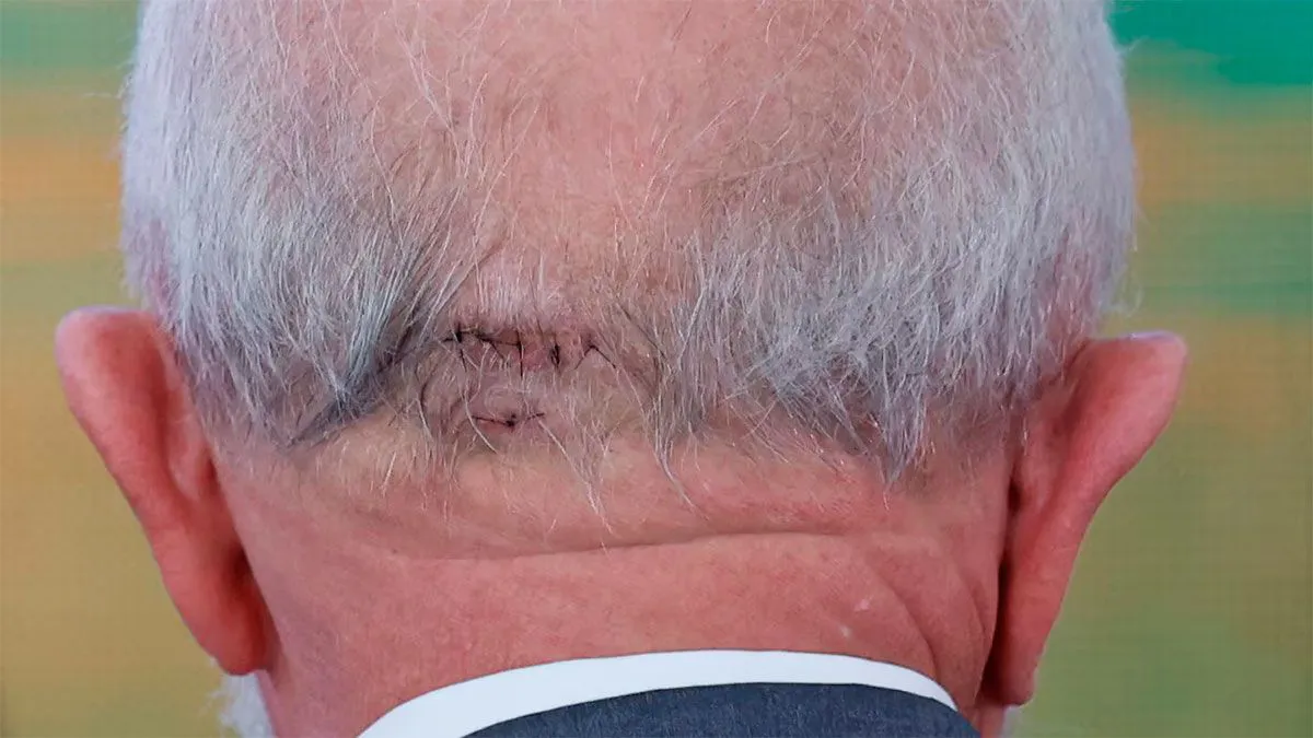 Lula da Silva tras el accidente