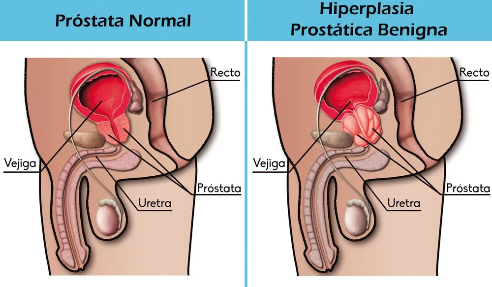 hiperplasia prostática benigna hiperplasia prostática benigna