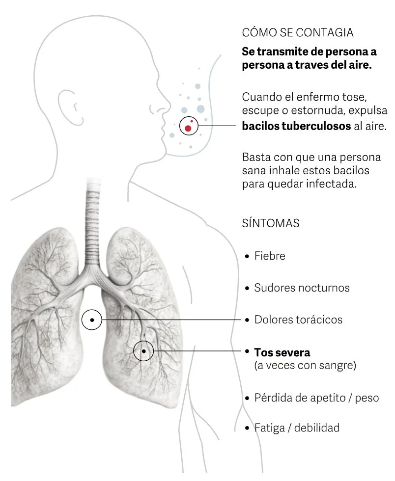 Cómo se contagia la tuberculosis.