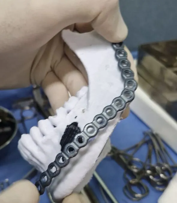 Las cirugías planificadas con impresiones 3D ya superan las 60 intervenciones