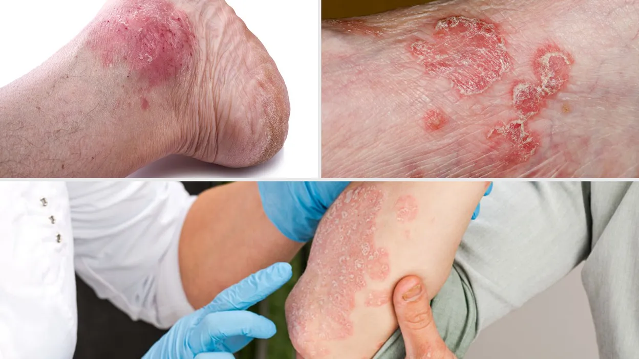 psoriasis psoriasis