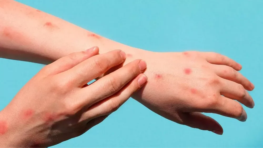 viruela del mono viruela del mono